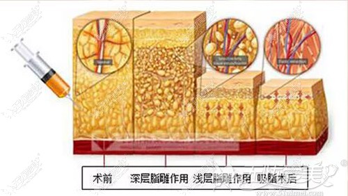 手臂吸脂不会反弹的原因