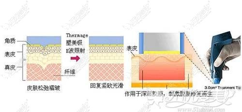 热玛吉眼部治疗原理