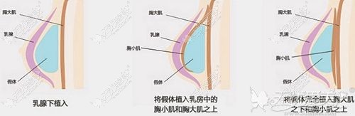 合肥华美假体隆胸手术假体植入