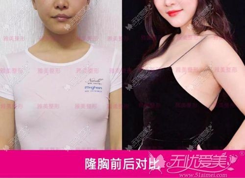 衡阳雅美假体隆胸前后对比