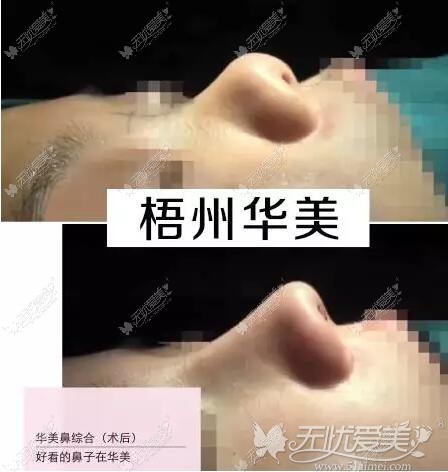 梧州华美鼻综合前后对比案例