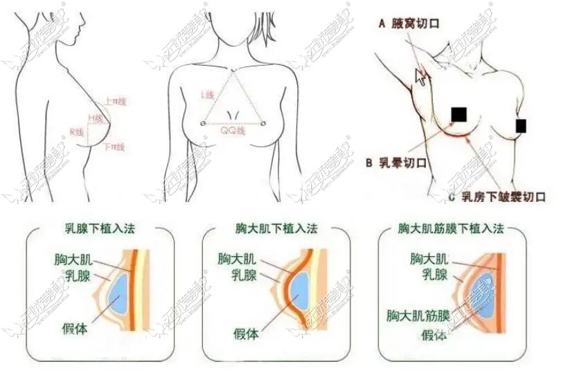 假体隆胸手术切口图片