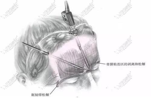 内窥镜小切口除皱原理