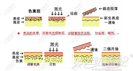 蜂巢皮秒祛斑的原理