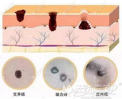 色素痣的多种类型