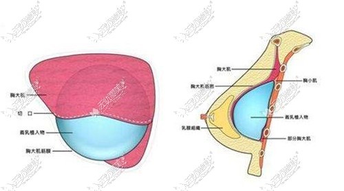 崔东隆胸技术口碑是真好