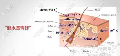冰点脱毛能有效改善毛发浓密问题