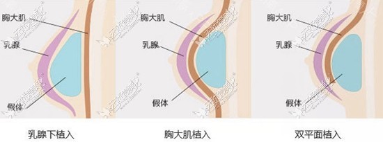 西安华仁假体隆胸植入位置