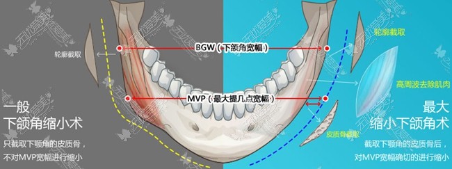 一般下颌角手术和mvp下颌角手术对比