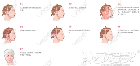 韩国清潭first纵深肌理归位术手术过程