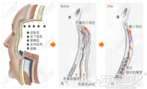 纵深肌理归位术手术原理