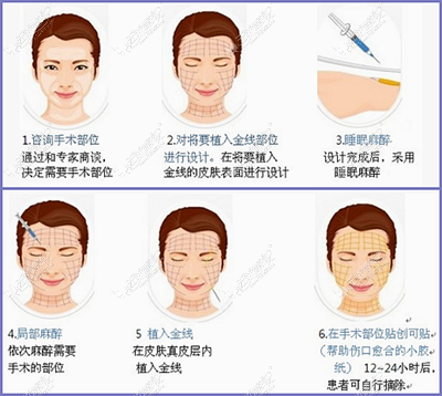 金线除皱手术过程