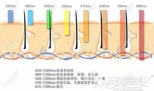 光子嫩肤可以去除痘痘