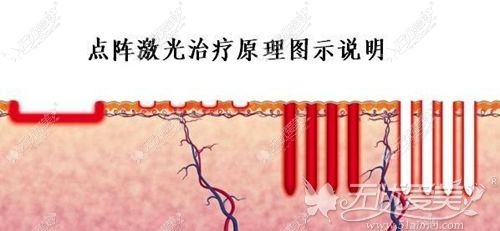 点阵激光可以改善痘坑痘印