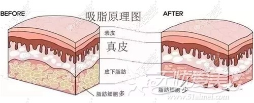 南宁东方360°水动力吸脂体雕术原理