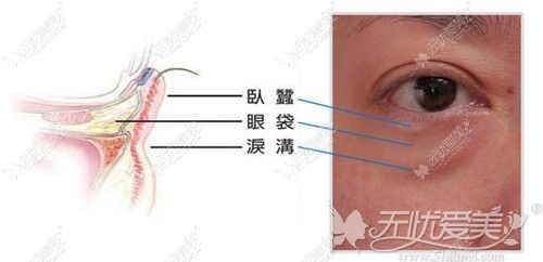 眼袋、卧蚕、泪沟的区别