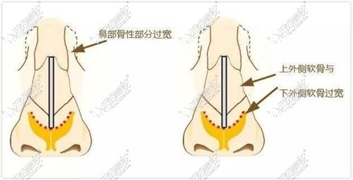 鼻骨内推手术效果