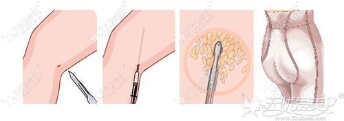 大腿吸脂手术原理