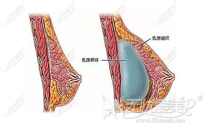 通过植入假体增大胸部的体积