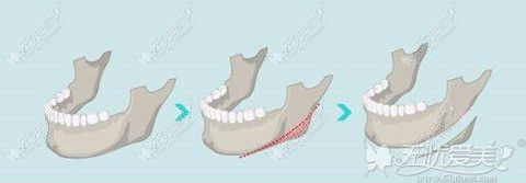下颌角整形手术过程