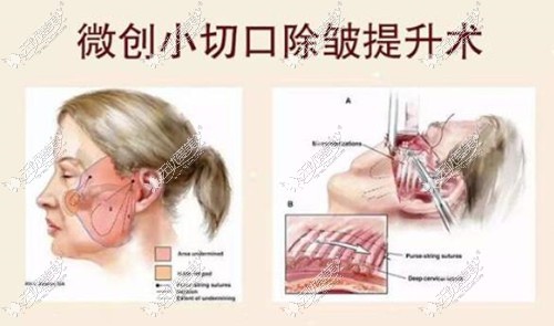 宁整小切口拉皮原理