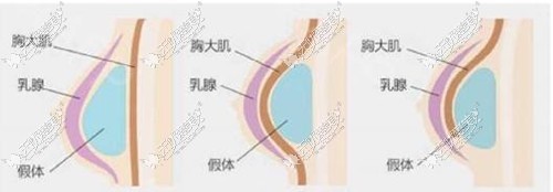 胸大肌的位置