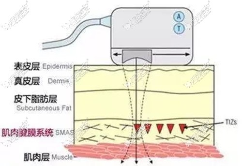 热拉提的作用原理