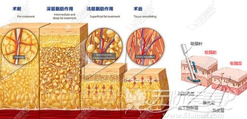 重庆军美多维立体吸脂手术原理