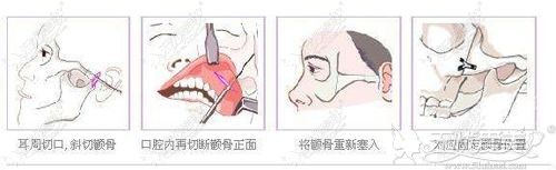 磨骨手术的原理