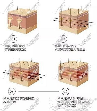 沧州京美提晓华告知面部线雕提升原理