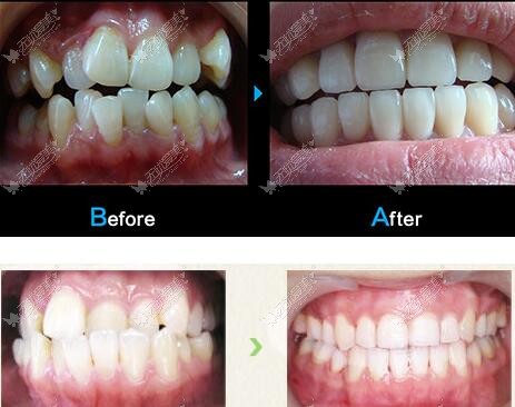 柳卫祖矫正牙齿更多案例
