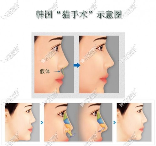 揭秘另类整形手术：韩国猫手术