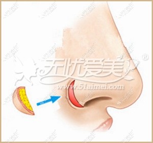 成都百龄鼻翼去薄术