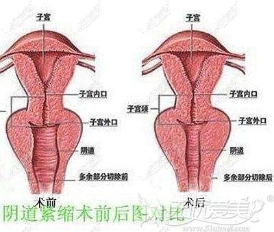 阴道紧缩术后效果对比