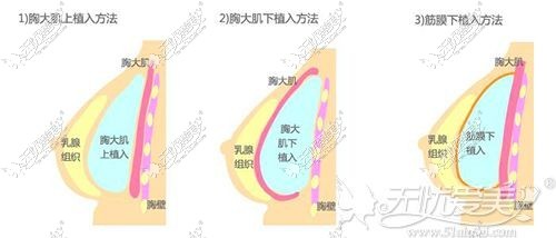 假体可以放置到的位置