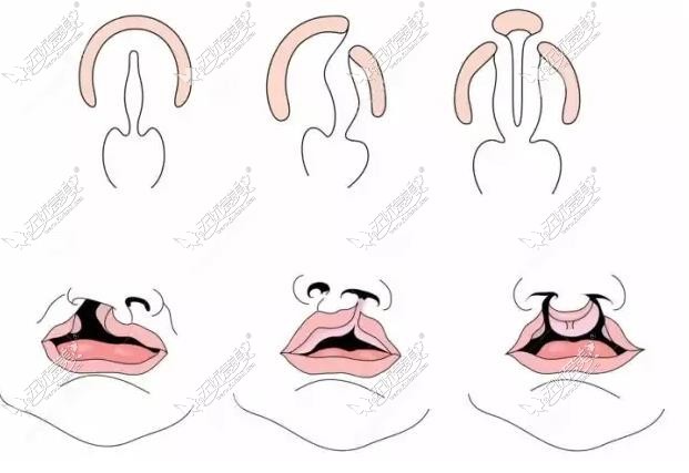 不同程度唇腭裂情况