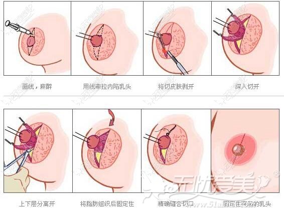 遵义红美乳头内陷矫正手术方法