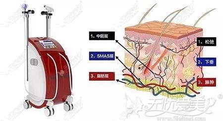 热拉提改善的面部皮肤层次