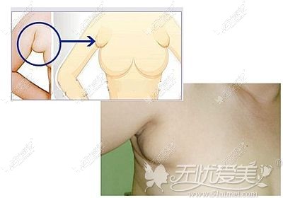 副乳的出现会影响美观