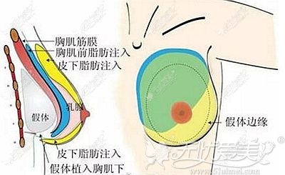 复合式隆胸的原理和优势