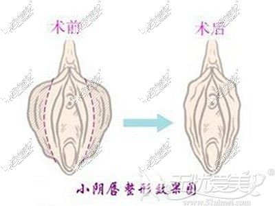 阴唇缩小手术的原理