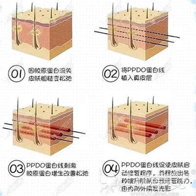 壹加壹PPDO蛋白线