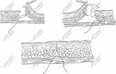 内缝合技术