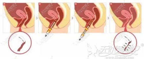 菲蜜丽治疗阴道松弛过程