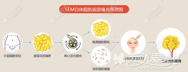 江苏施尔美SEM自体脂肪面部填充