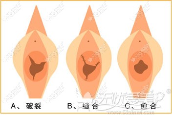 温州东方女子医院处女膜修复技术恢复过程