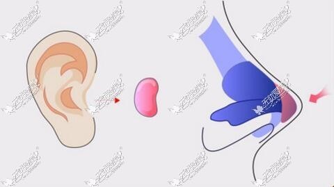 徐学东耳软骨隆鼻技术