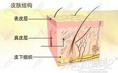 点阵激光洗纹身的皮肤层次