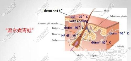 冰点脱毛能有效改善毛发浓密问题