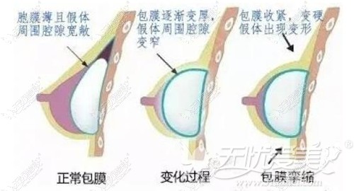 成都铜雀台分析隆胸假体包膜挛缩的过程